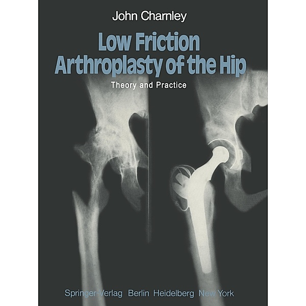 Low Friction Arthroplasty of the Hip, J. Charnley
