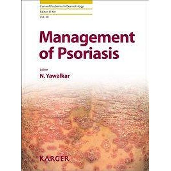 Management of Psoriasis