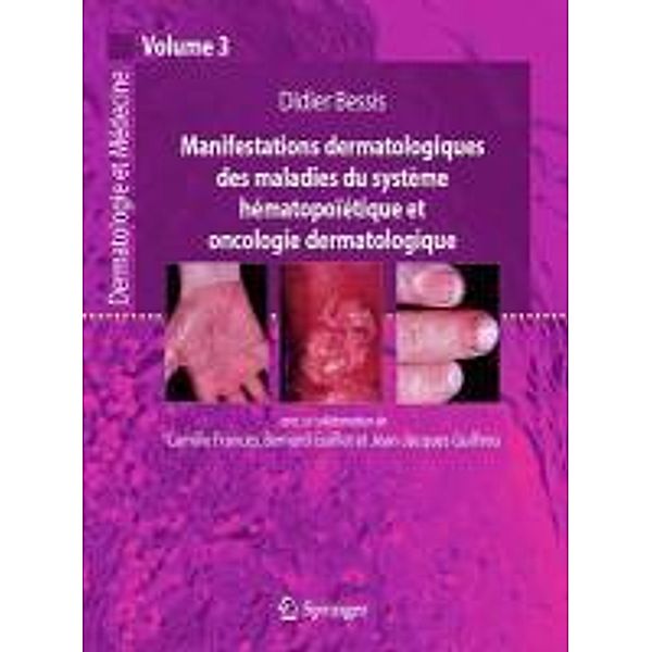 Manifestations dermatologiques des maladies du système hématopoïétique et oncologie dermatologique