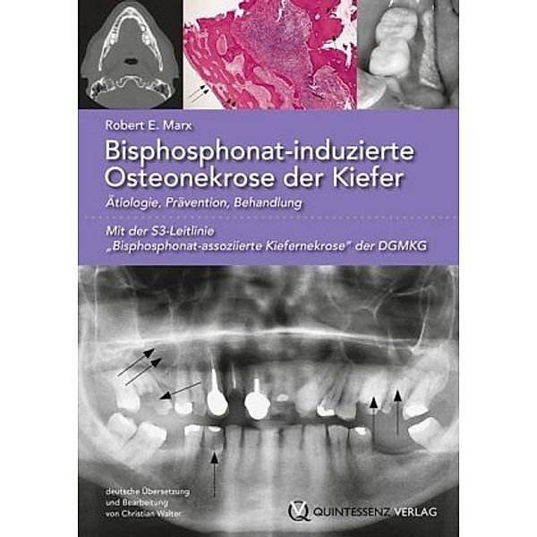 Marx, R: Bisphosphonat-induzierte Osteonekrose der Kiefer, Robert E. Marx