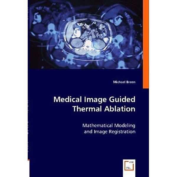 Medical Image Guided Thermal Ablation, Michael Breen