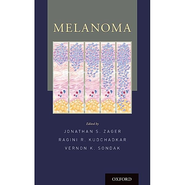 Melanoma