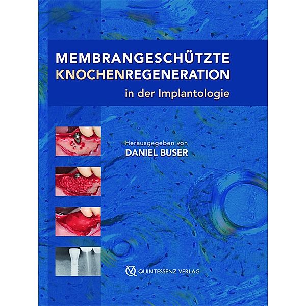 Membrangeschützte Knochenregeneration in der Implantologie, Daniel Buser