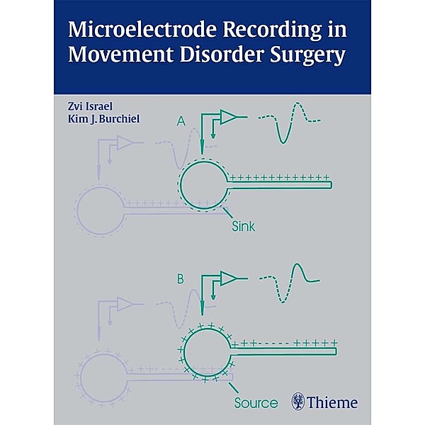 Microelectrode Recording in Movement Disorder Surgery