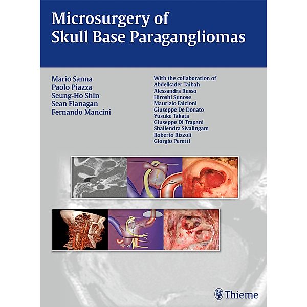 Microsurgery of Skull Base Paragangliomas, Mario Sanna