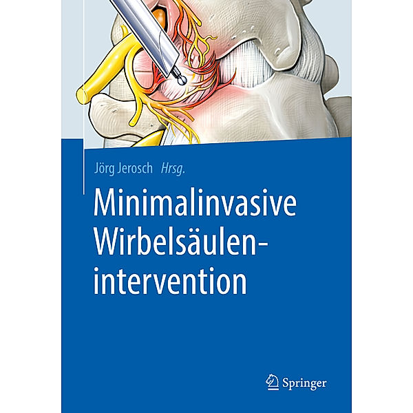 Minimalinvasive Wirbelsäulenintervention