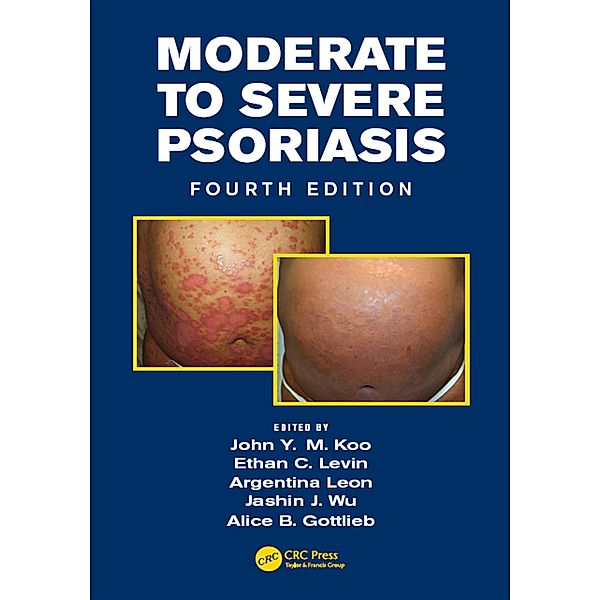 Moderate to Severe Psoriasis