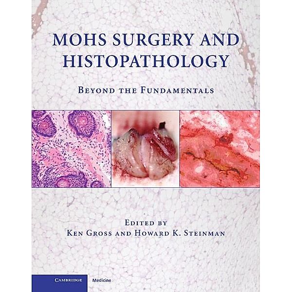 Mohs Surgery and Histopathology