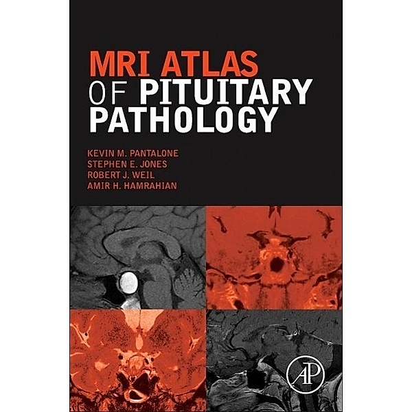 MRI Atlas of Pituitary Pathology, Kevin M. Pantalone, Stephen E. Jones, Robert J. Weil