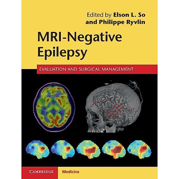 MRI-Negative Epilepsy