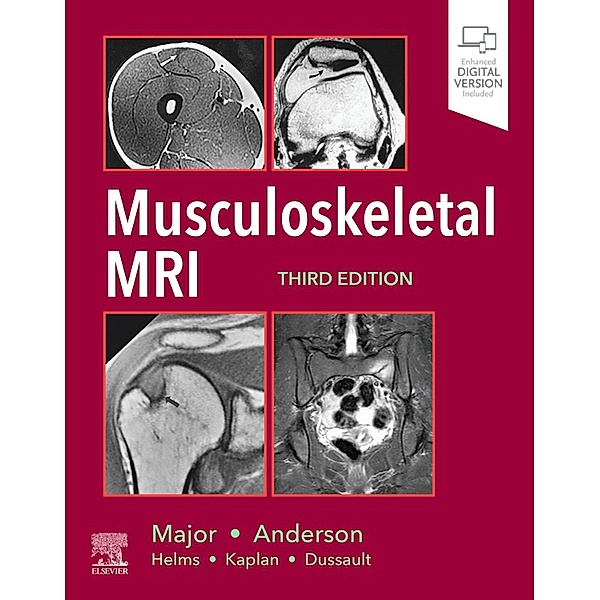 Musculoskeletal MRI E-Book, Nancy M. Major, Mark W. Anderson
