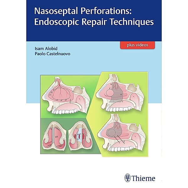 Nasoseptal Perforations: Endoscopic Repair Techniques