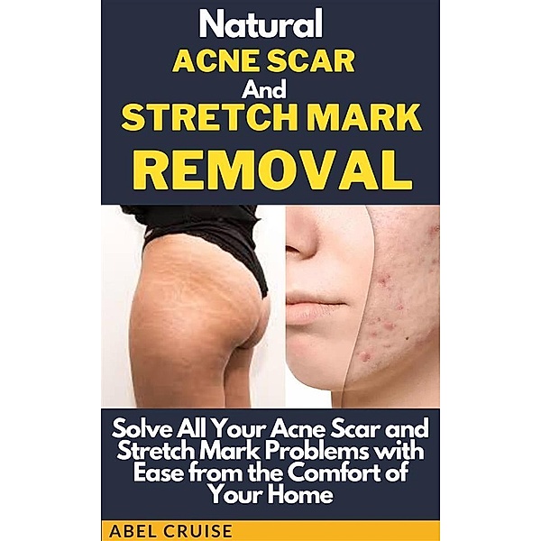 Natural Acne Scar and Stretch Mark Removal, Cruise Abel