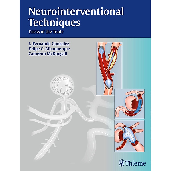 Neurointerventional Techniques, Fernando Gonzalez, Felipe Albuquerque, Cameron G. McDougall