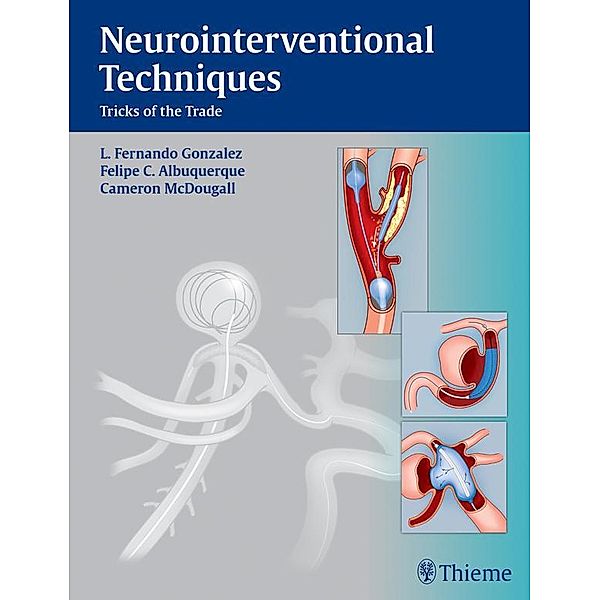 Neurointerventional Techniques, Fernando L. Gonzalez, Felipe C. Albuquerque, Cameron G. McDougall