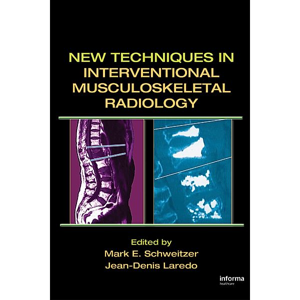 New Techniques in Interventional Musculoskeletal Radiology