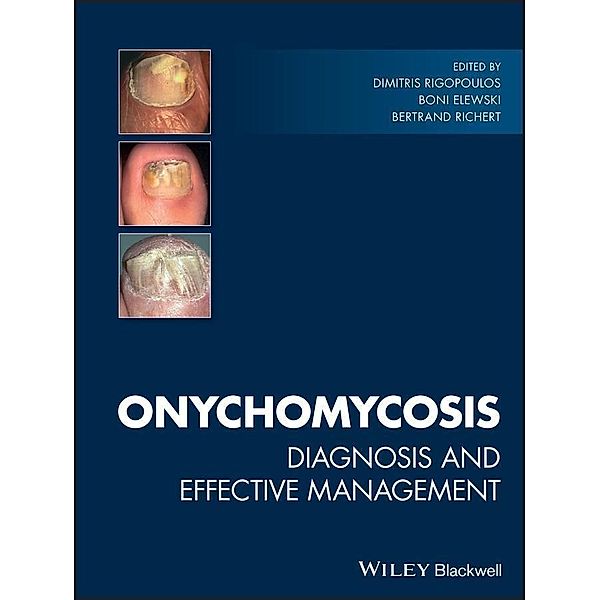 Onychomycosis