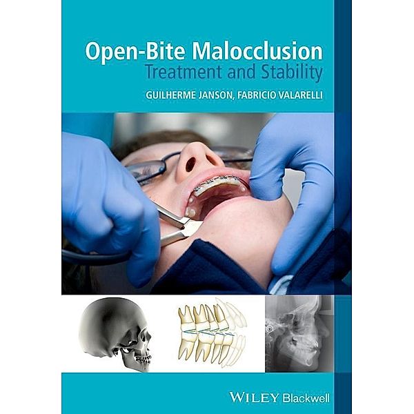 Open-Bite Malocclusion