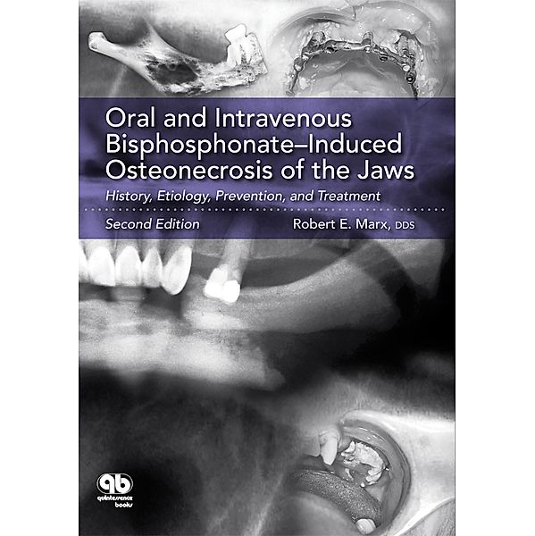 Oral and Intravenous Bisphosphonate-Induced Osteonecrosis of the Jaws, Robert E. Marx