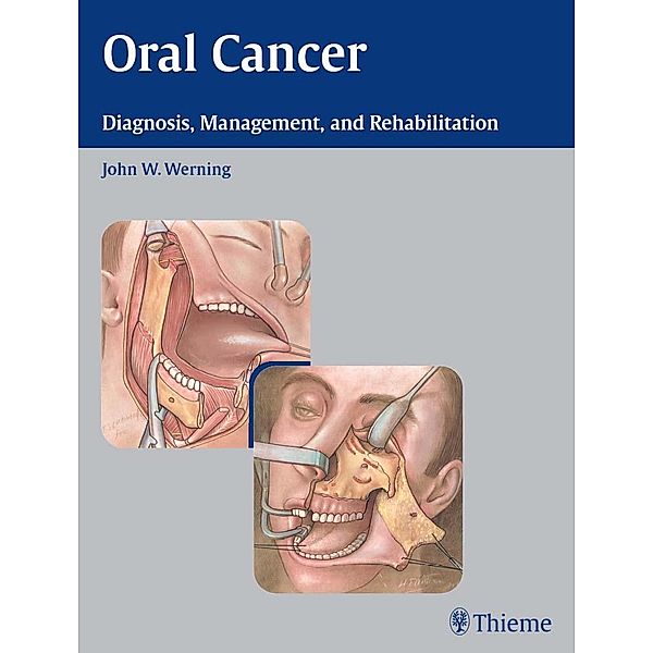 Oral Cancer