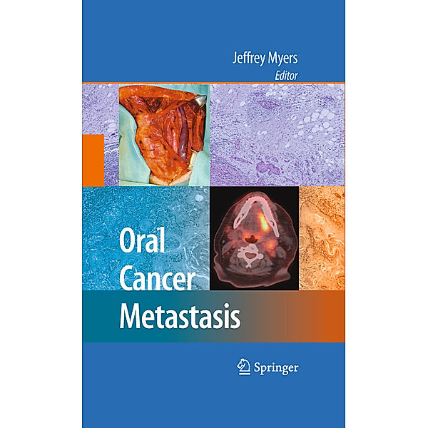 Oral Cancer Metastasis