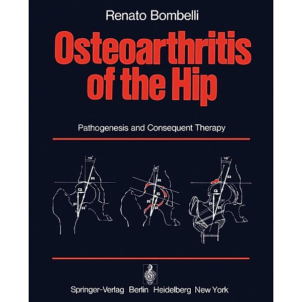 Osteoarthritis of the Hip, R. Bombelli