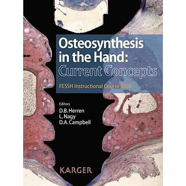 Osteosynthesis in the Hand: Current Concepts