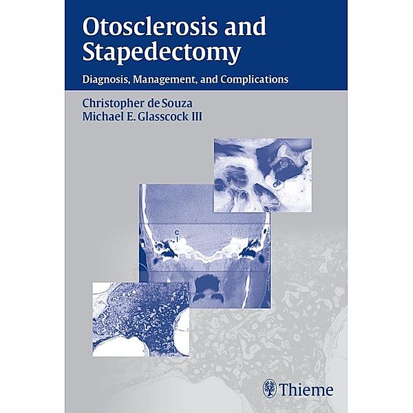 Otosclerosis and Stapedectomy