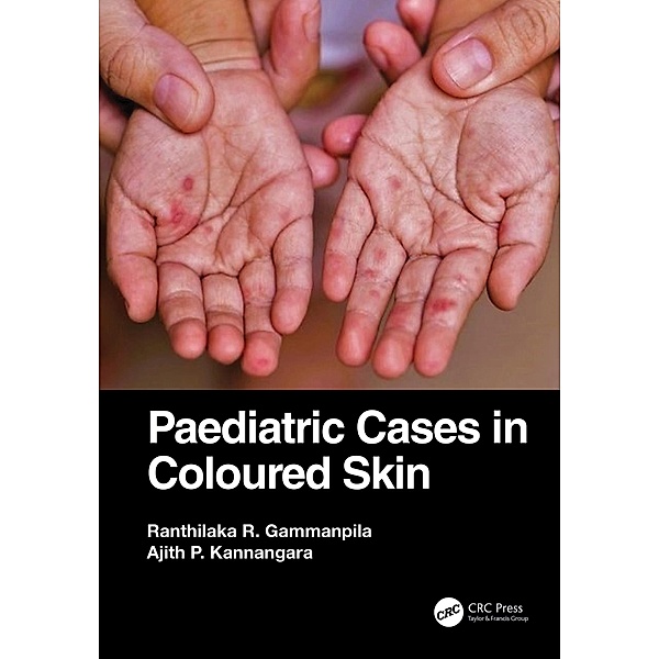 Paediatric Cases in Coloured Skin, Ranthilaka R. Gammanpila, Ajith P. Kannangara
