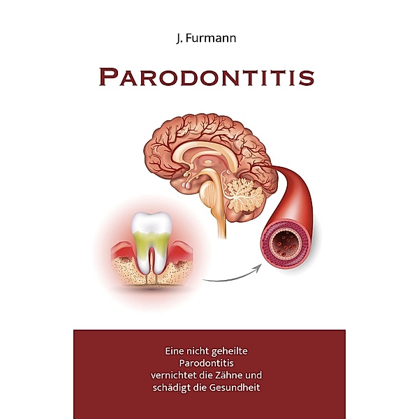 Parodontitis, J. Furmann
