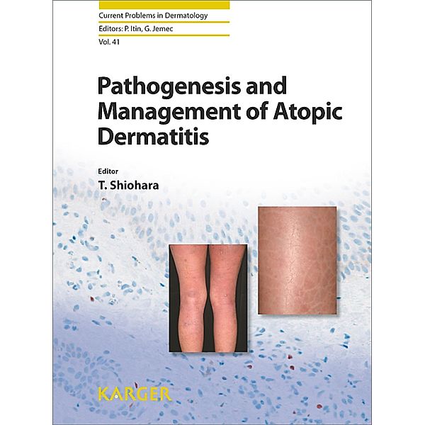 Pathogenesis and Management of Atopic Dermatitis