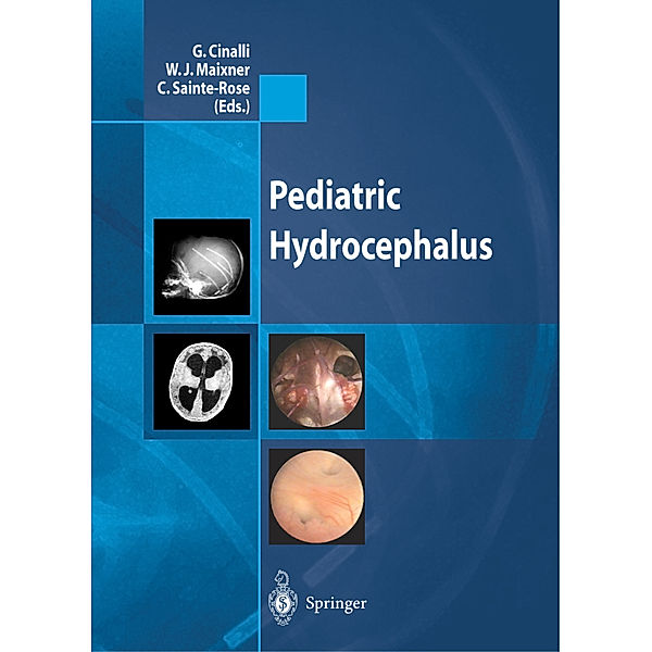 Pediatric Hydrocephalus