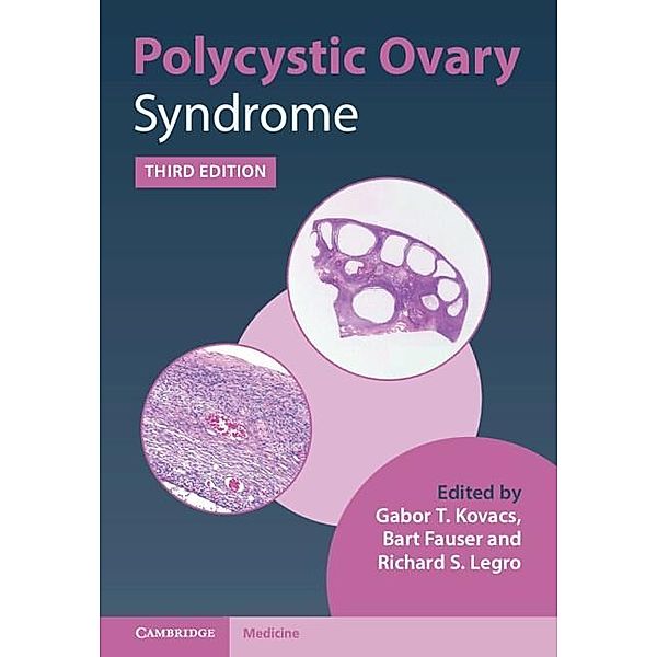 Polycystic Ovary Syndrome