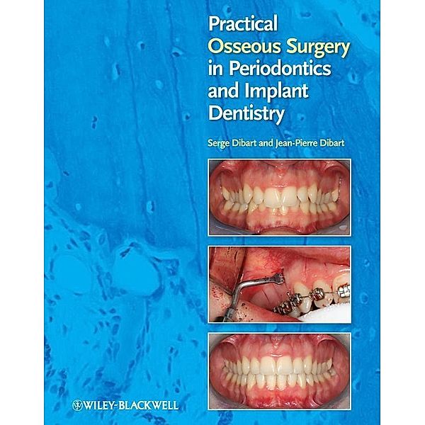 Practical Osseous Surgery in Periodontics and Implant Dentistry, Serge Dibart, Jean-Pierre Dibart