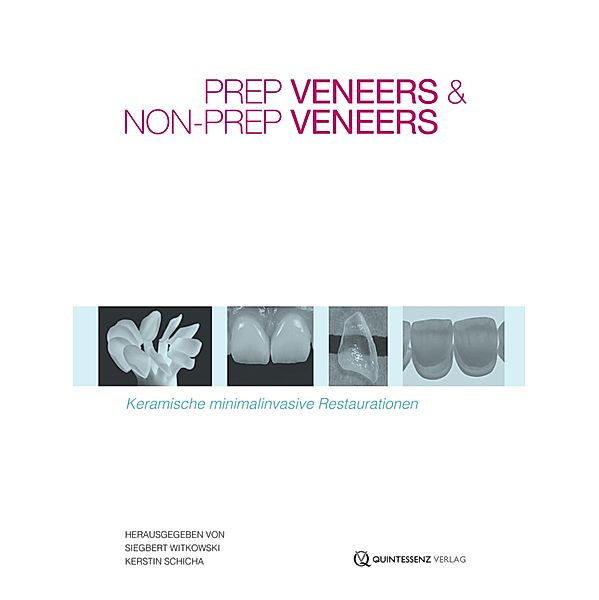 Prep Veneers und Non-Prep Veneers, Siegbert Witkowski, Kerstin Schicha