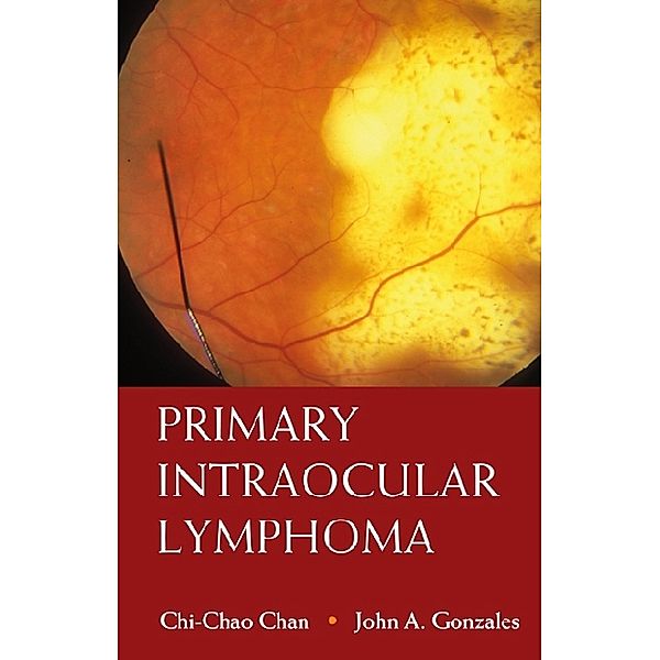 Primary Intraocular Lymphoma, Chi-Chao Chan, John A Gonzales