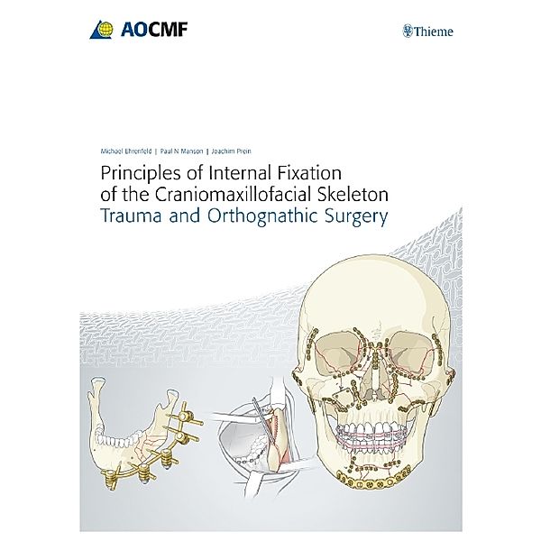 Principles of Internal Fixation of the Craniomaxillofacial Skeleton, Michael Ehrenfeld, Paul N. Manson, Joachim Prein