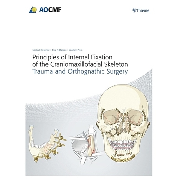 Principles of Internal Fixation of the Craniomaxillofacial Skeleton, Michael Ehrenfeld, Paul N. Manson, Joachim Prein