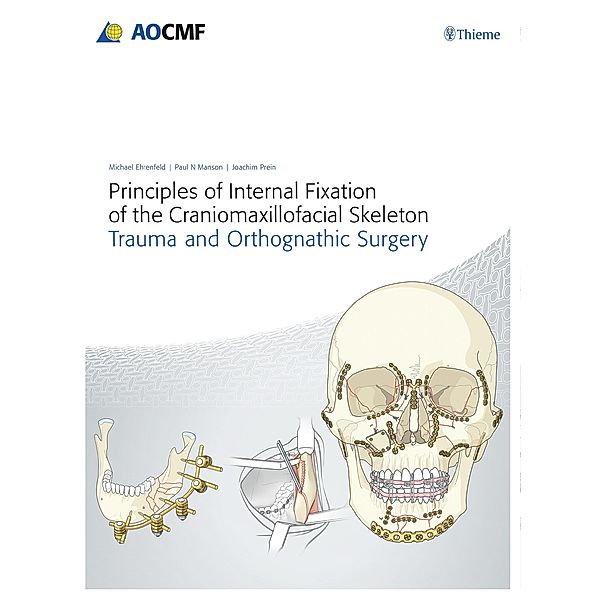 Principles of Internal Fixation of the Craniomaxillofacial Skeleton, Joachim Prein, Michael Ehrenfeld, Paul N. Manson