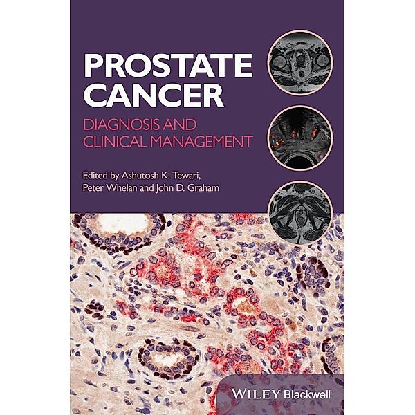 Prostate Cancer