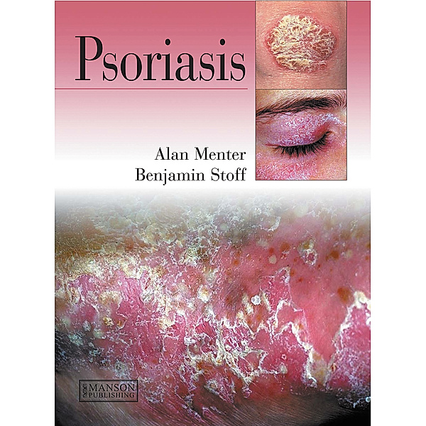 Psoriasis, M. Alan Menter, Benjamin Stoff