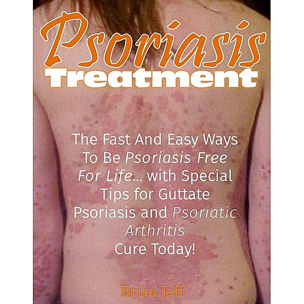 Psoriasis Treatment: The Fast and Easy Ways to Be Psoriasis Free for Life... with Special Tips for Guttate Psoriasis and Psoriatic Arthritis Cure Today!, Brian Jeff