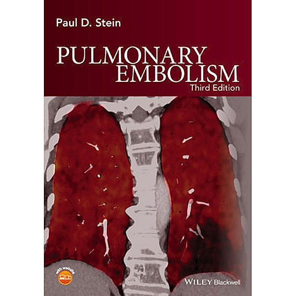 Pulmonary Embolism, Paul D. Stein