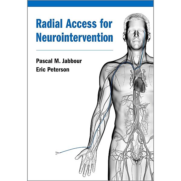 Radial Access for Neurointervention