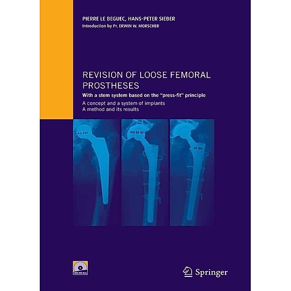 Revision of loose femoral prostheses with a stem system based on the press-fit principle, Pierre Le Béguec, Hans-Peter Sieber