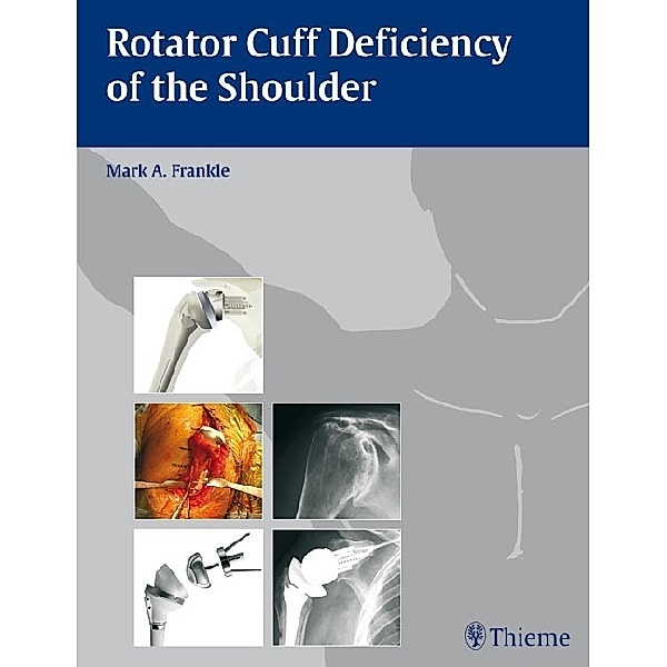 Rotator Cuff Deficiency of the Shoulder, Mark A. Frankle