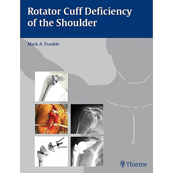 Rotator Cuff Deficiency of the Shoulder