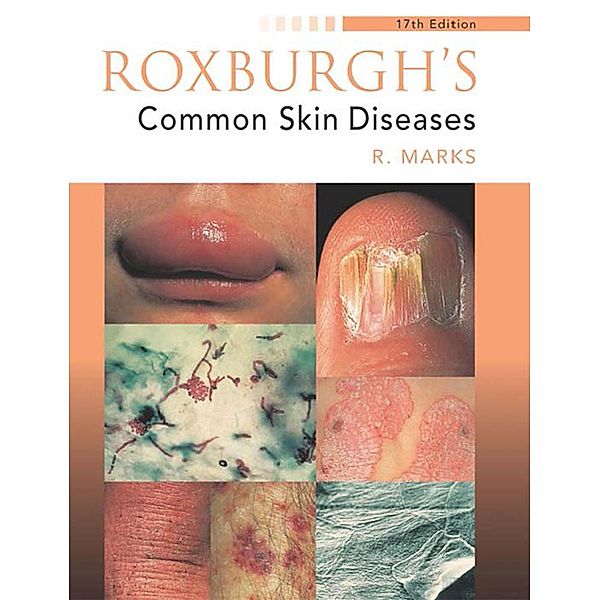 Roxburgh's Common Skin Diseases, 17Ed, Ronald Marks