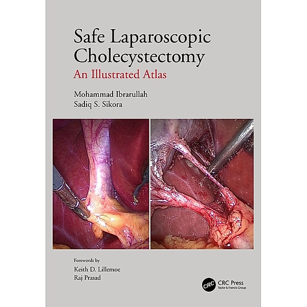 Safe Laparoscopic Cholecystectomy, Mohammad Ibrarullah, Sadiq S Sikora