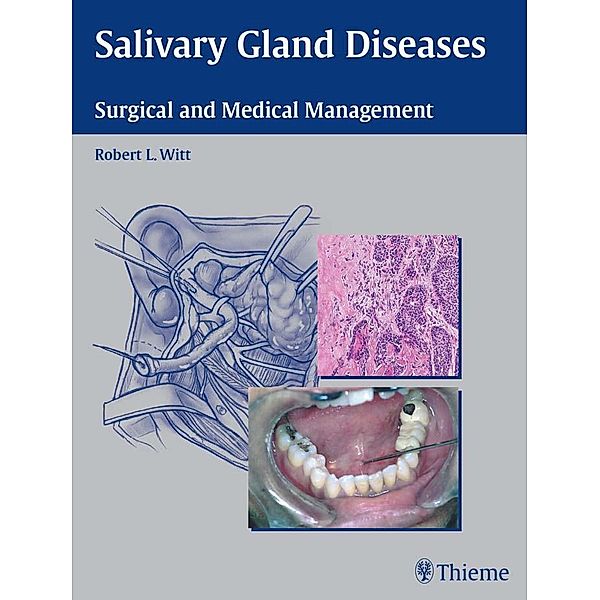 Salivary Gland Diseases